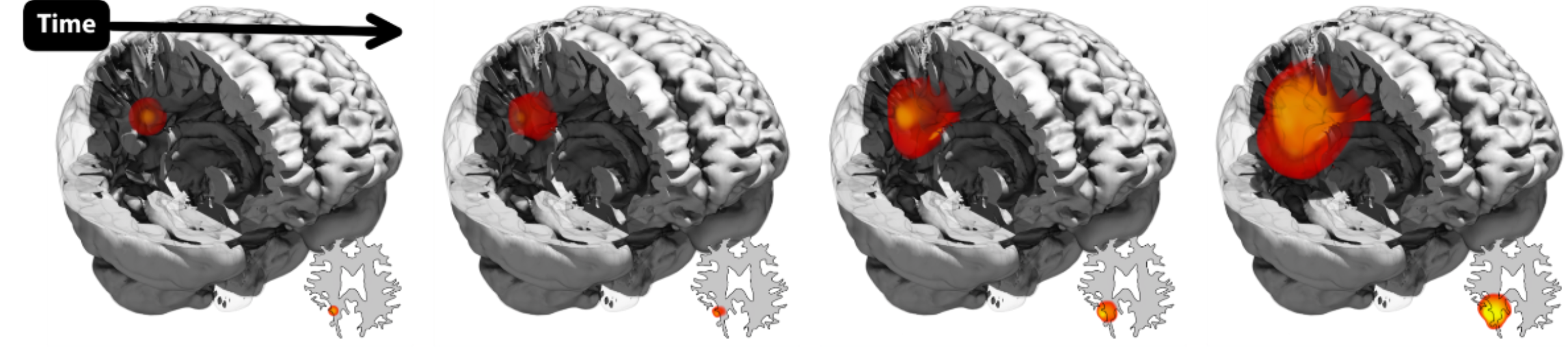 GliODIL spatio-temporal tumor cell distribution over time